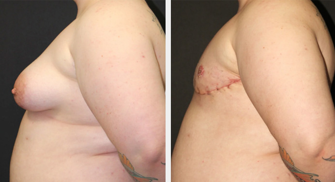 FTM-top-surgery-dr-garg-before-after-01-03