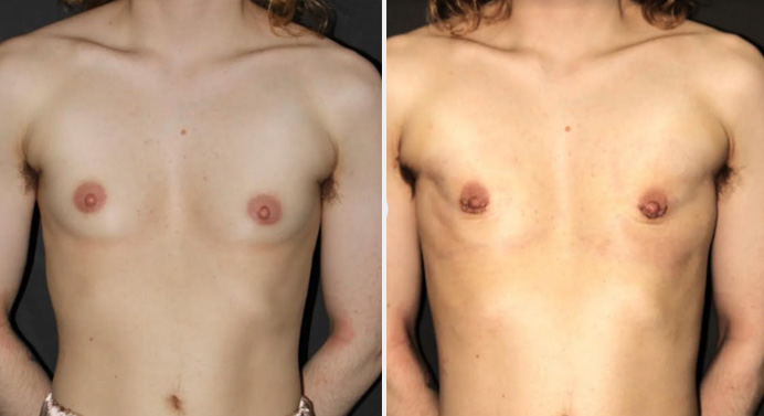 FTM-top-surgery-dr-garg-before-after-02-02