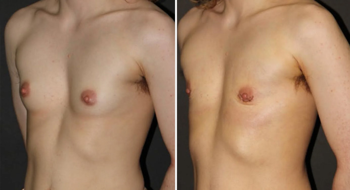 FTM-top-surgery-dr-garg-before-after-02