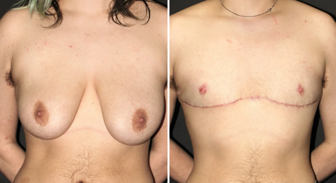 FTM-top-surgery-dr-garg-before-after-03-02