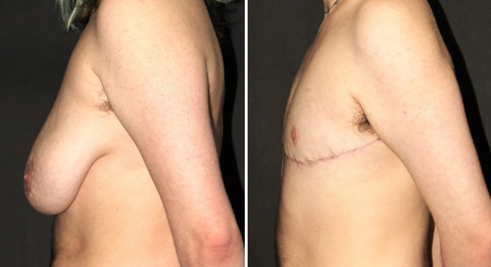 FTM-top-surgery-dr-garg-before-after-03-03