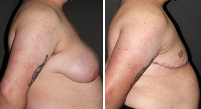 FTM-top-surgery-dr-garg-before-after-04-02