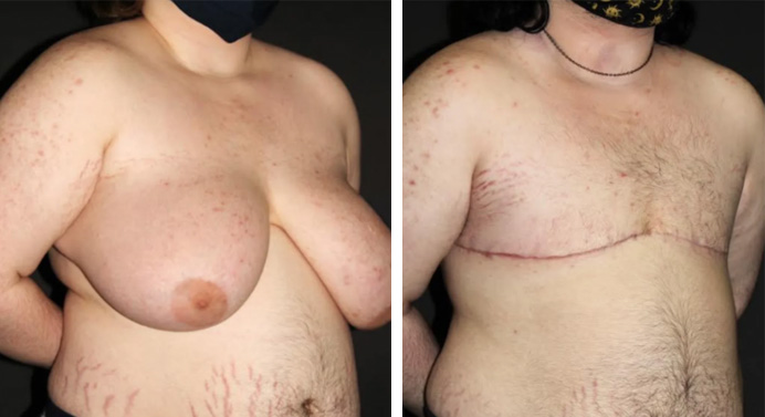 FTM-top-surgery-dr-garg-before-after-05-01