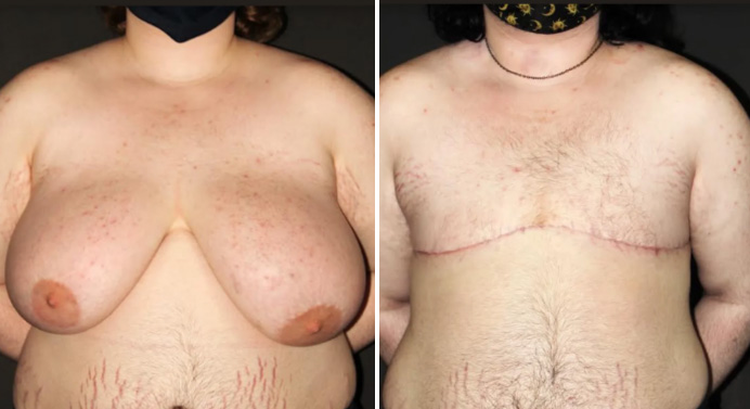 FTM-top-surgery-dr-garg-before-after-05-03