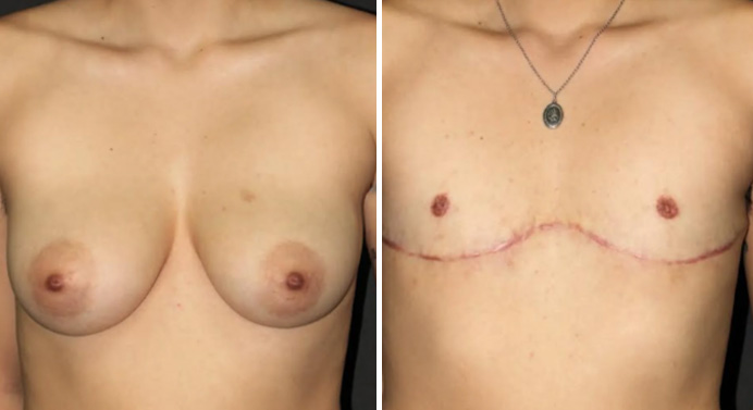 FTM-top-surgery-dr-garg-before-after-06-01
