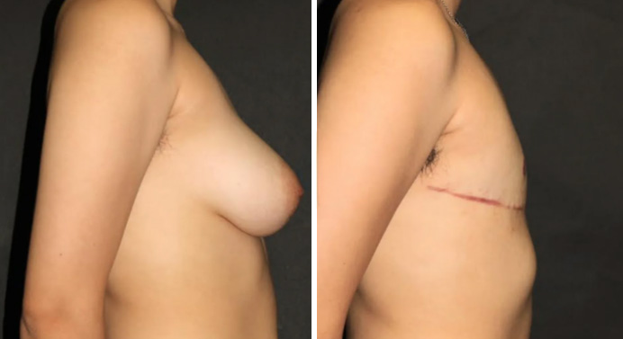 FTM-top-surgery-dr-garg-before-after-06-02