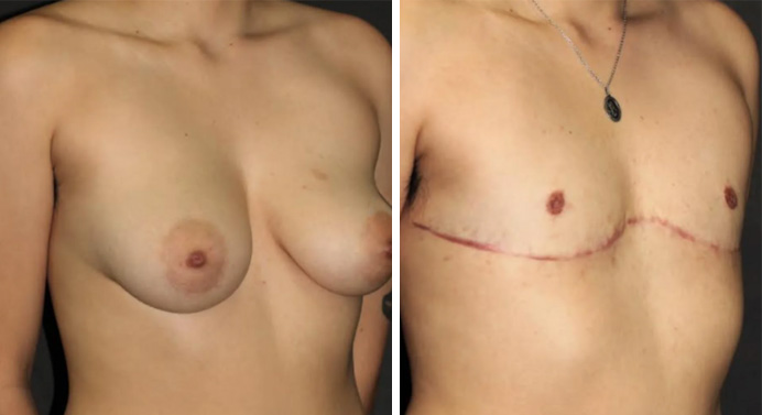 FTM-top-surgery-dr-garg-before-after-06-03