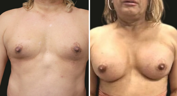 MTF-top-surgery-dr-garg-before-after-01