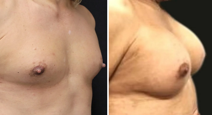 MTF-top-surgery-dr-garg-before-after-02