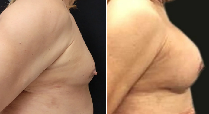 MTF-top-surgery-dr-garg-before-after-03