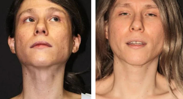 tracheal-shave-dr-garg-before-after-02